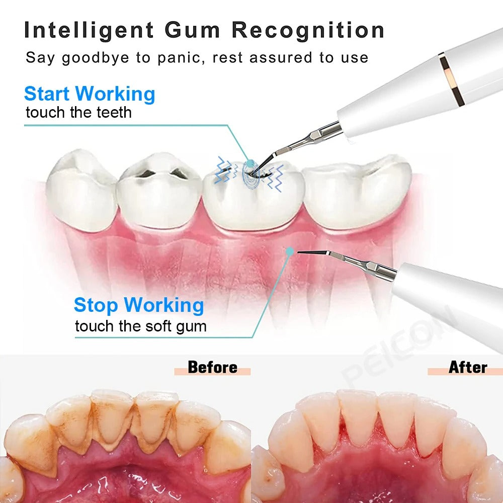 Ultrasonic Plaque/Tartar Remover for Teeth, Dental Calculus Remover Teeth Cleaning Kit