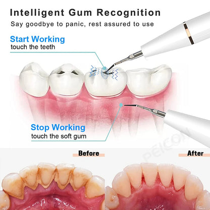Ultrasonic Plaque/Tartar Remover for Teeth, Dental Calculus Remover Teeth Cleaning Kit